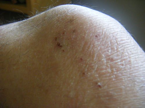 picture of eczema on the knee